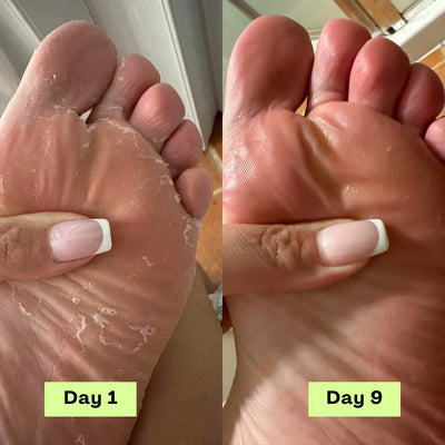 Vitae+ Anti Fungus Soap